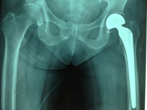 thay khớp háng bán phần ở bệnh nhân gãy liên mấu chuyển